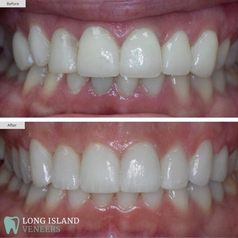 Long Island Veneers Before & After Patient 101
