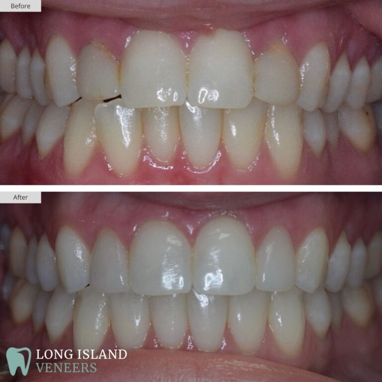 Long Island Veneers Before & After Patient 102