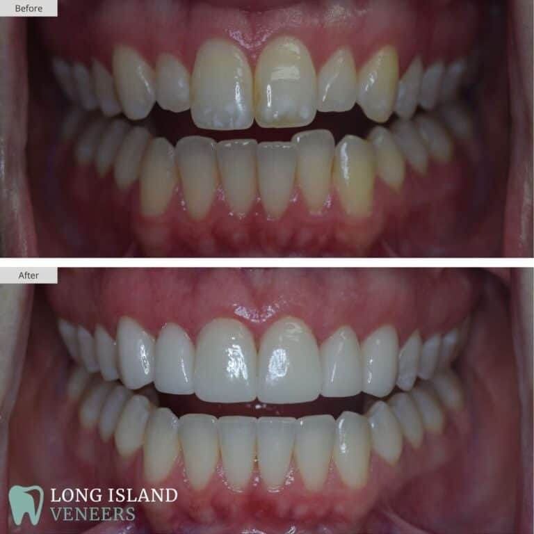 Long Island Veneers Before & After Patient 104