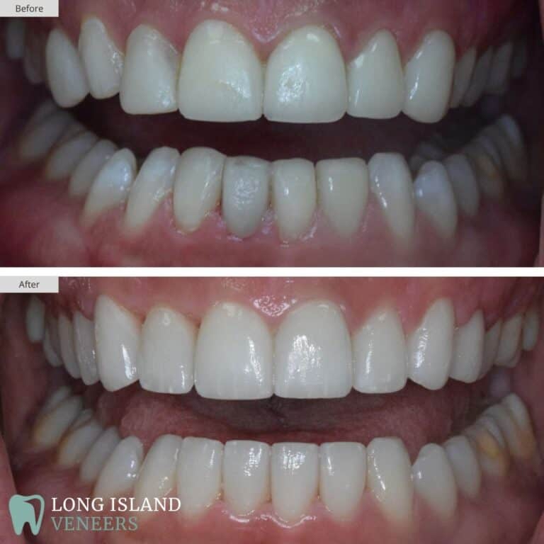 Long Island Veneers Before & After Patient 105