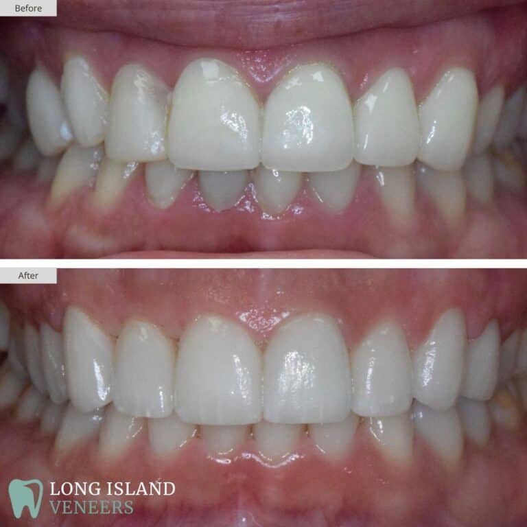 Long Island Veneers Before & After Patient 106