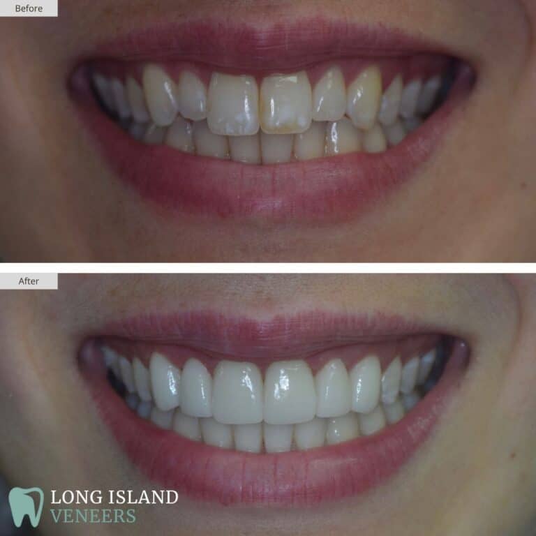 Long Island Veneers Before & After Patient 107