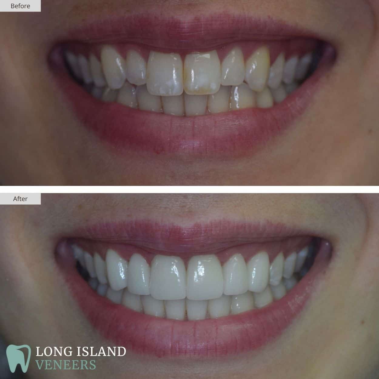 Long Island Veneers Before & After Patient 107