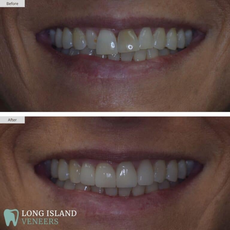 Long Island Veneers Before & After Patient 108