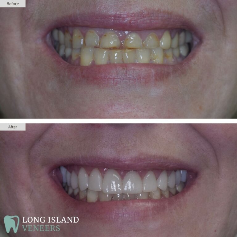 Long Island Veneers Before & After Patient 109