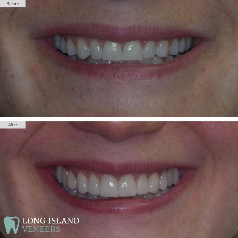 Long Island Veneers Before & After Patient 110