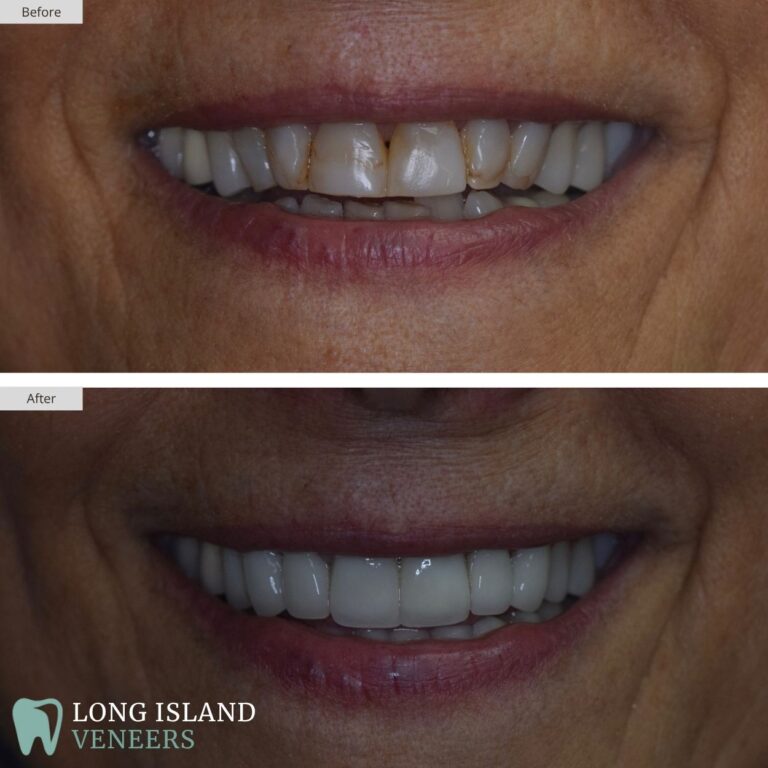 Long Island Veneers Before & After Patient 112