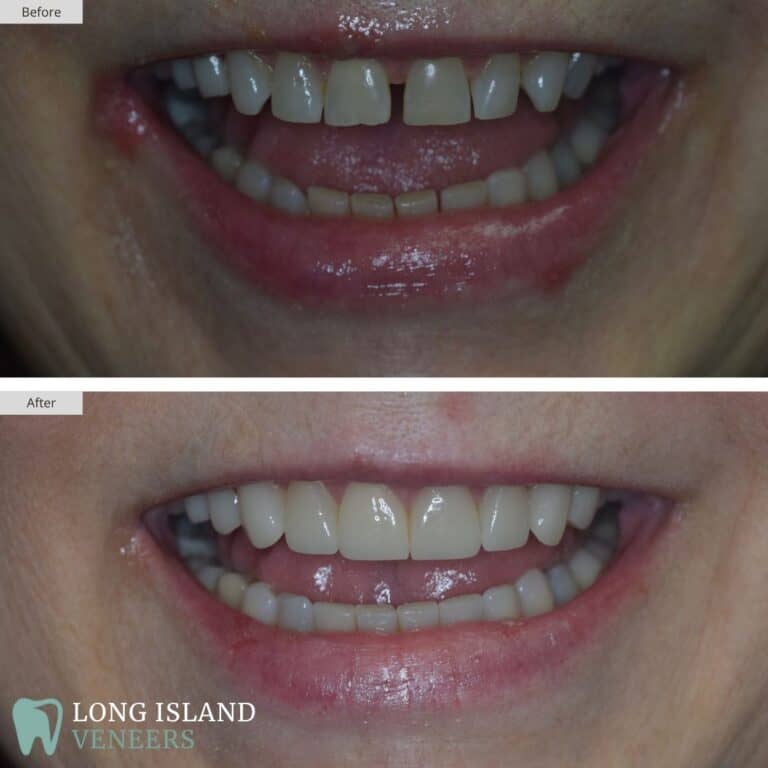 Long Island Veneers Before & After Patient 113