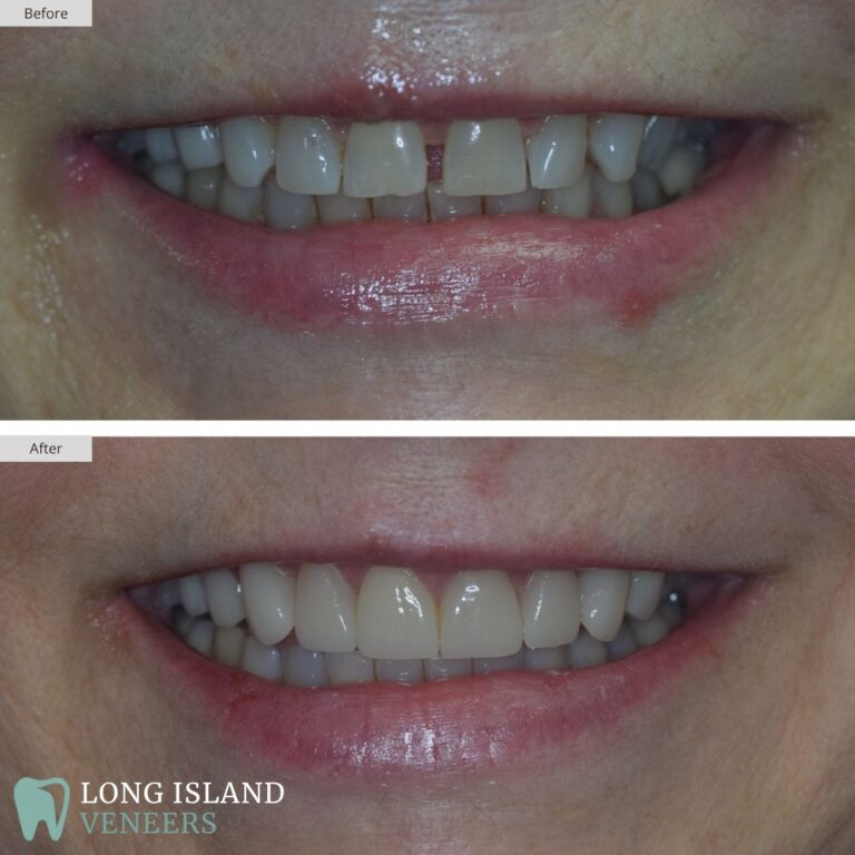 Long Island Veneers Before & After Patient 114