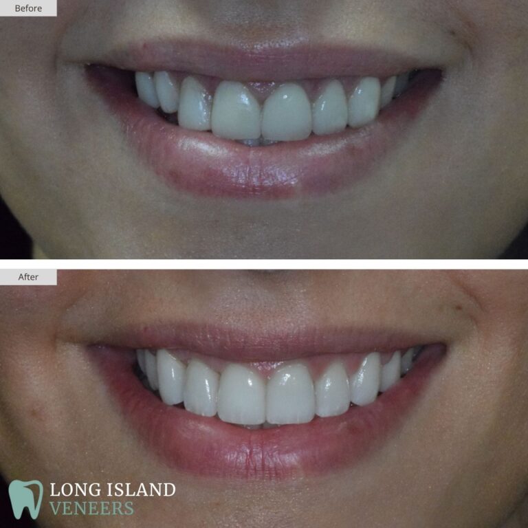 Long Island Veneers Before & After Patient 115