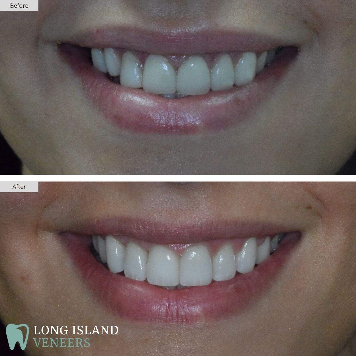Long Island Veneers Before & After Patient 115