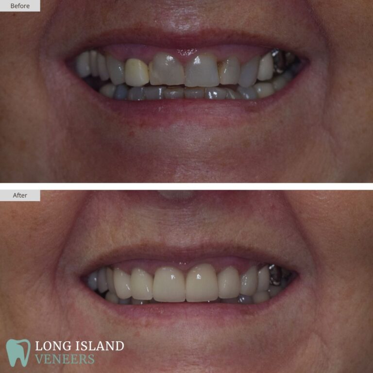 Long Island Veneers Before & After Patient 117