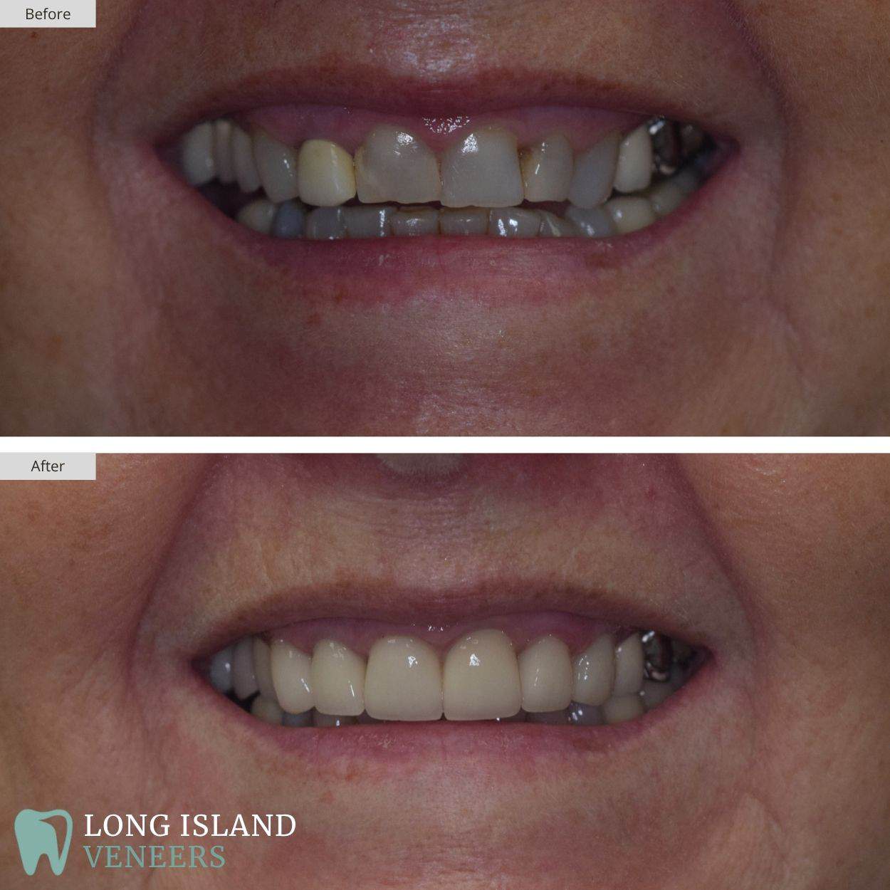 Long Island Veneers Before & After Patient 117