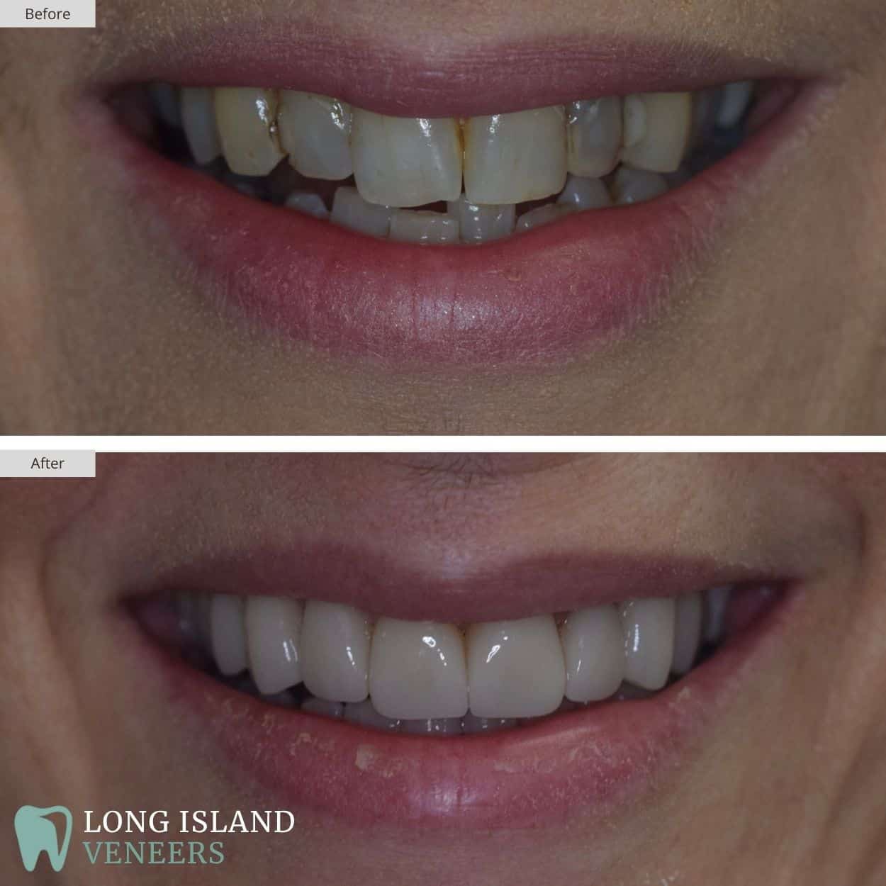 Long Island Veneers Before & After Patient 118