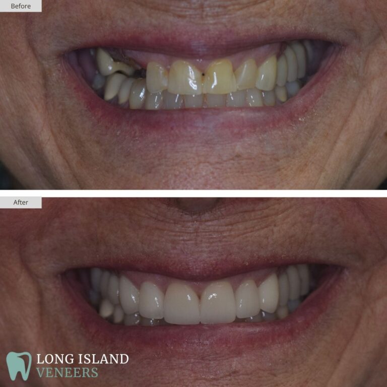 Long Island Veneers Before & After Patient 119