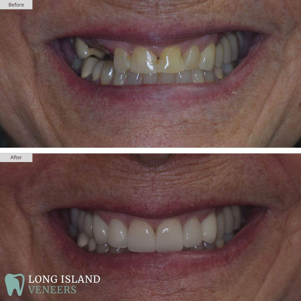 Long Island Veneers Before & After Patient 119