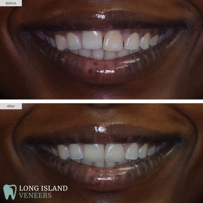 Long Island Veneers Before & After Patient 120