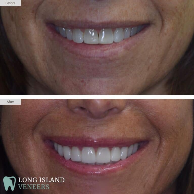 Long Island Veneers Before & After Patient 121