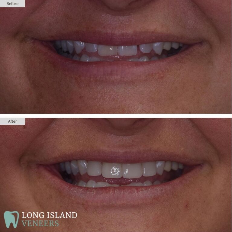 Long Island Veneers Before & After Patient 122