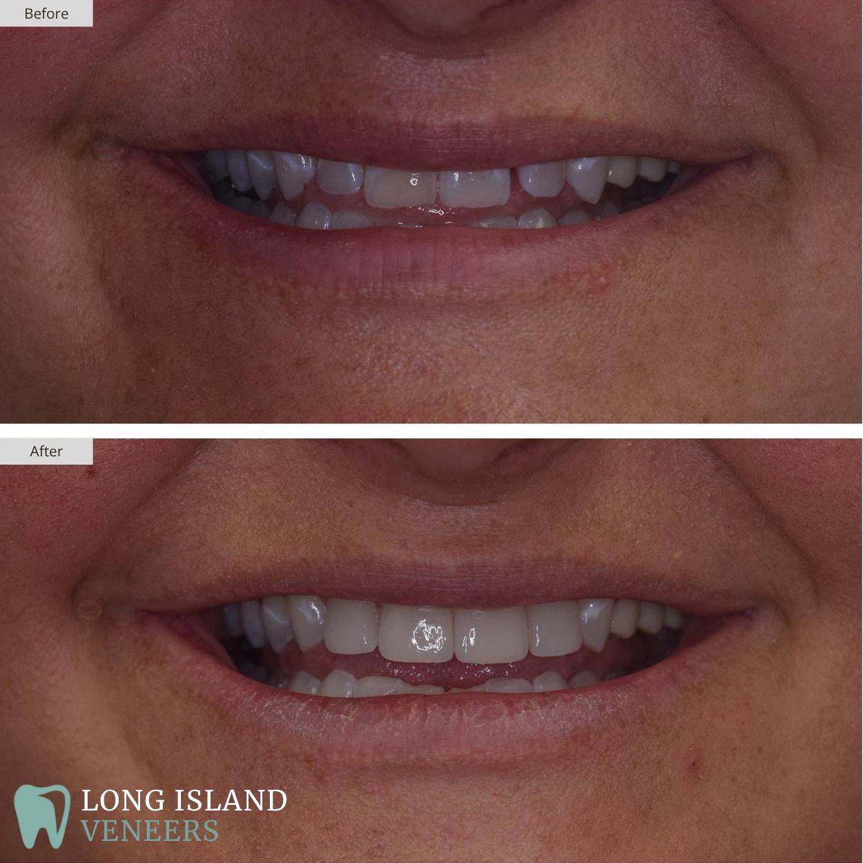 Long Island Veneers Before & After Patient 122