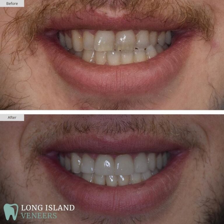 Long Island Veneers Before & After Patient 123