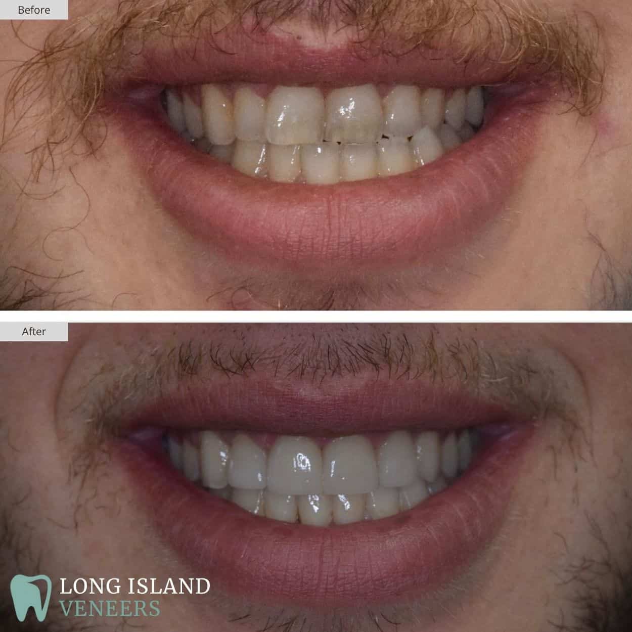 Long Island Veneers Before & After Patient 123