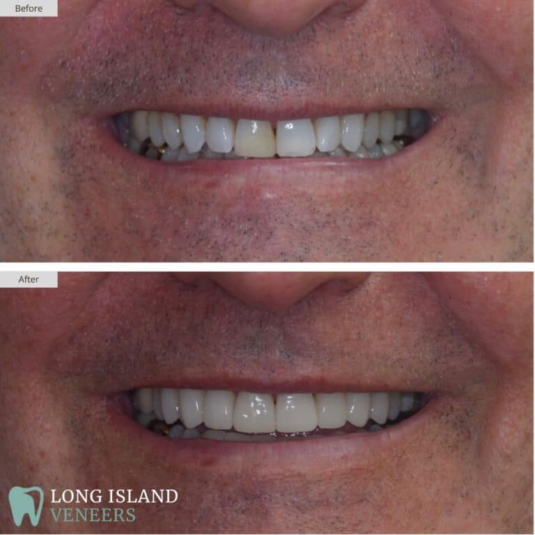 Long Island Veneers Before & After Patient 124