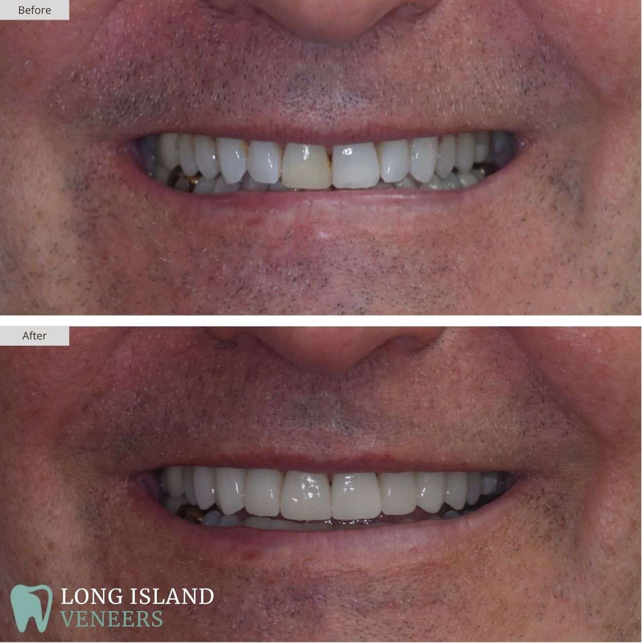 Long Island Veneers Before & After Patient 124