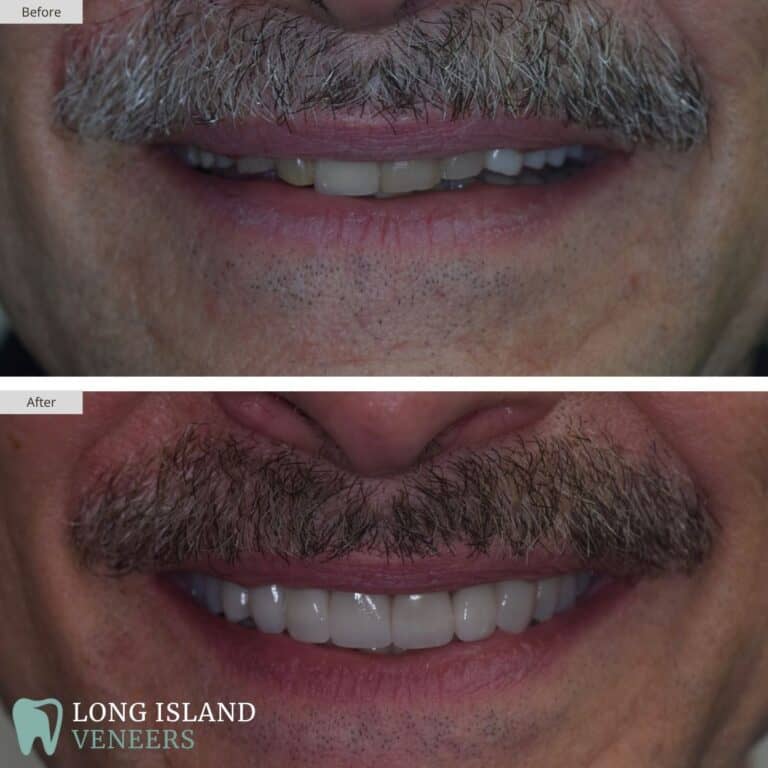 Long Island Veneers Before & After Patient 125