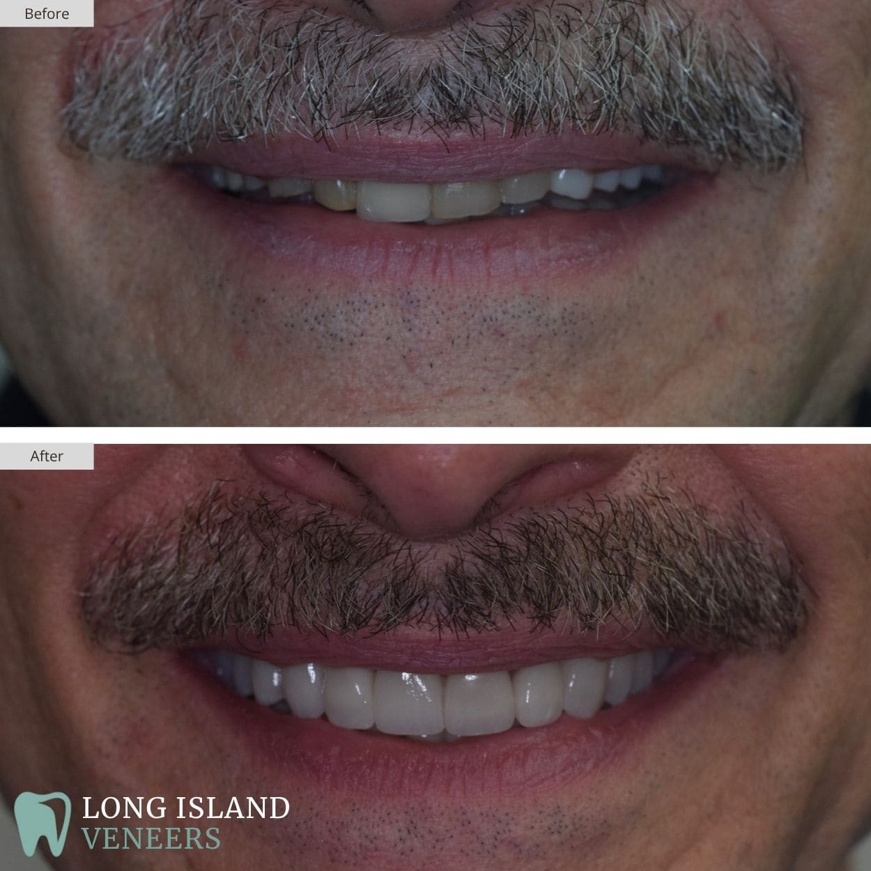 Long Island Veneers Before & After Patient 125