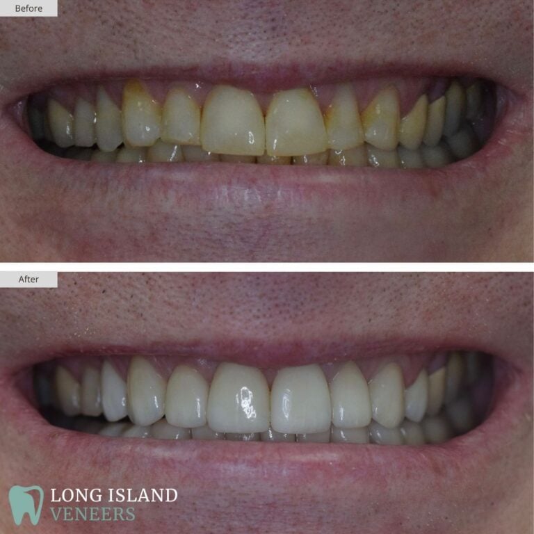 Long Island Veneers Before & After Patient 126