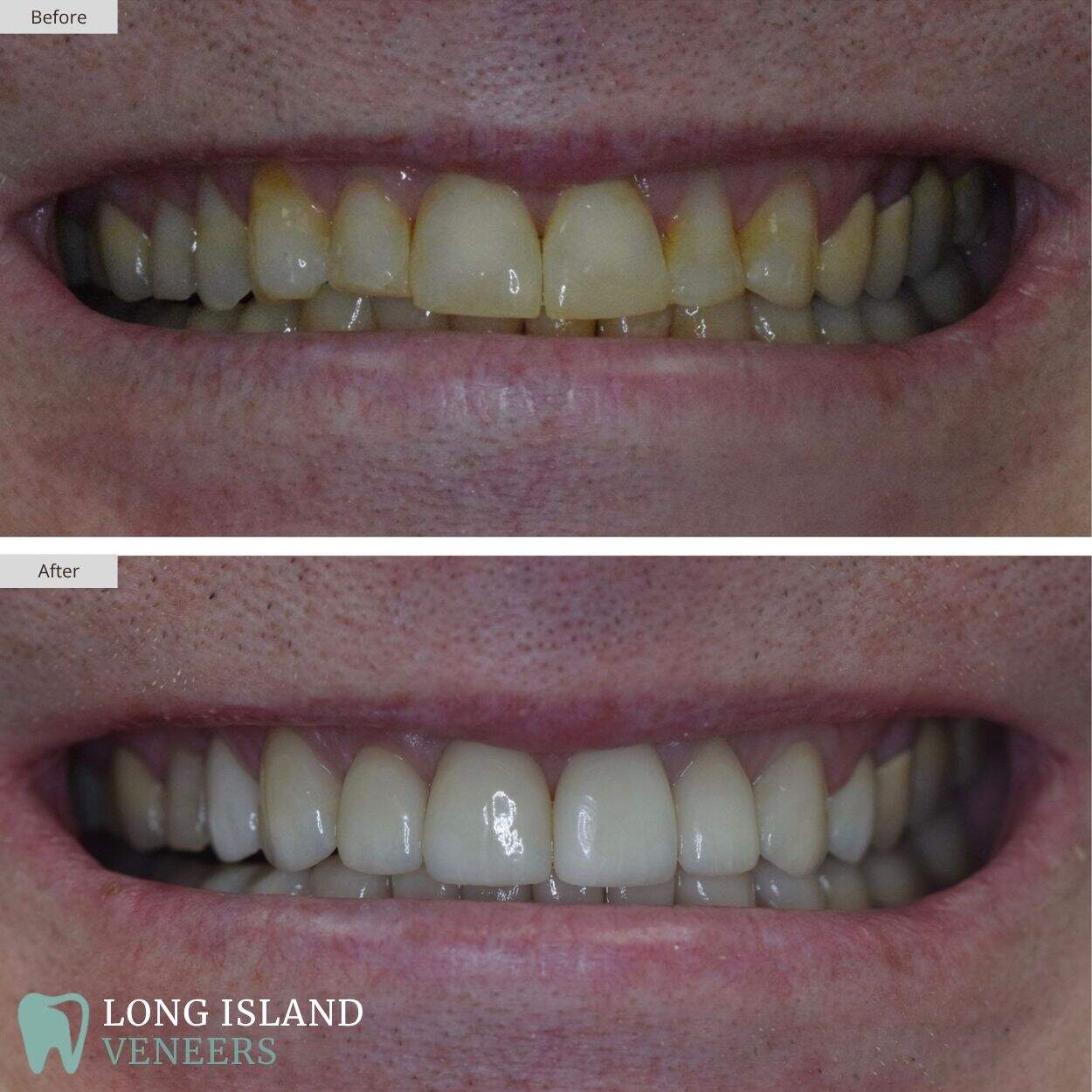 Long Island Veneers Before & After Patient 126