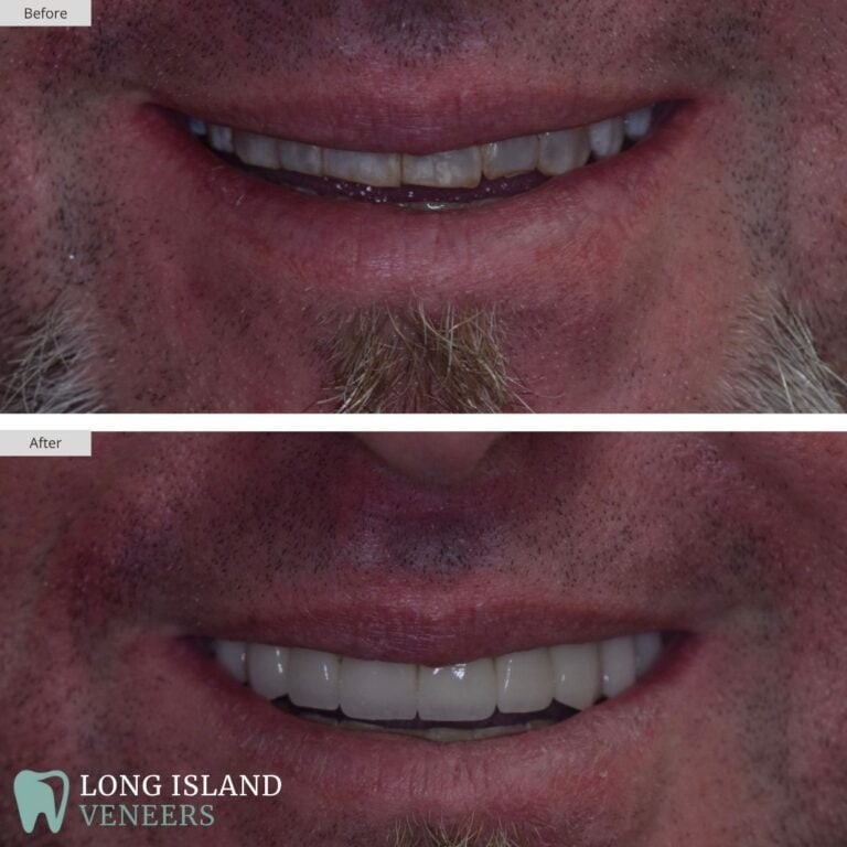 Long Island Veneers Before & After Patient 127