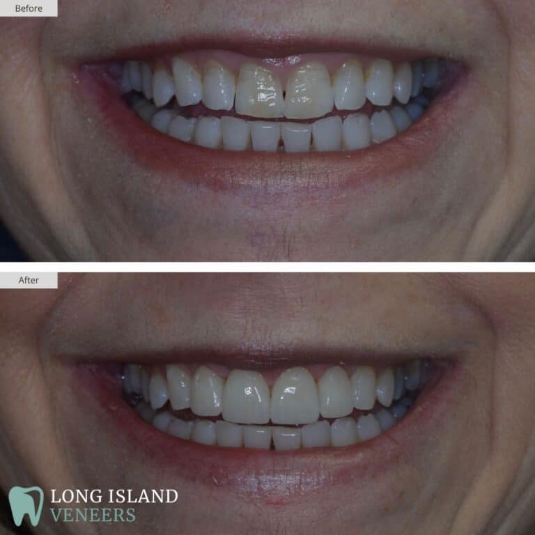 Long Island Veneers Before & After Patient 128