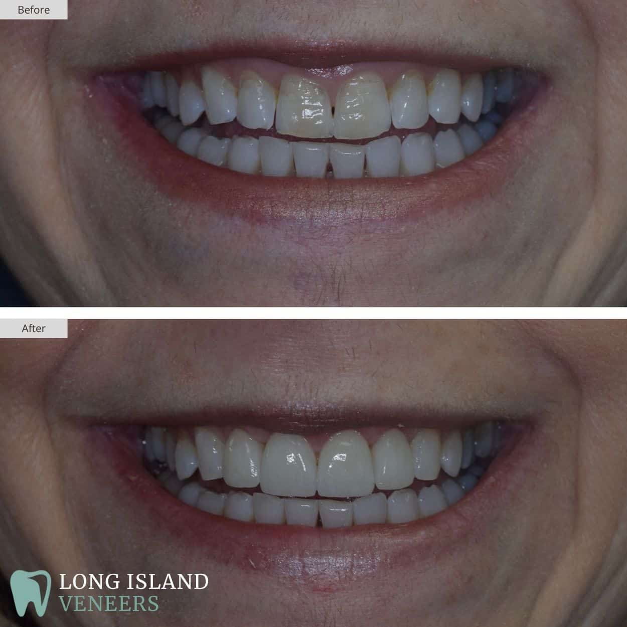 Long Island Veneers Before & After Patient 128