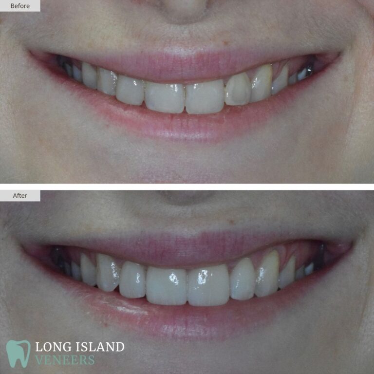 Long Island Veneers Before & After Patient 129