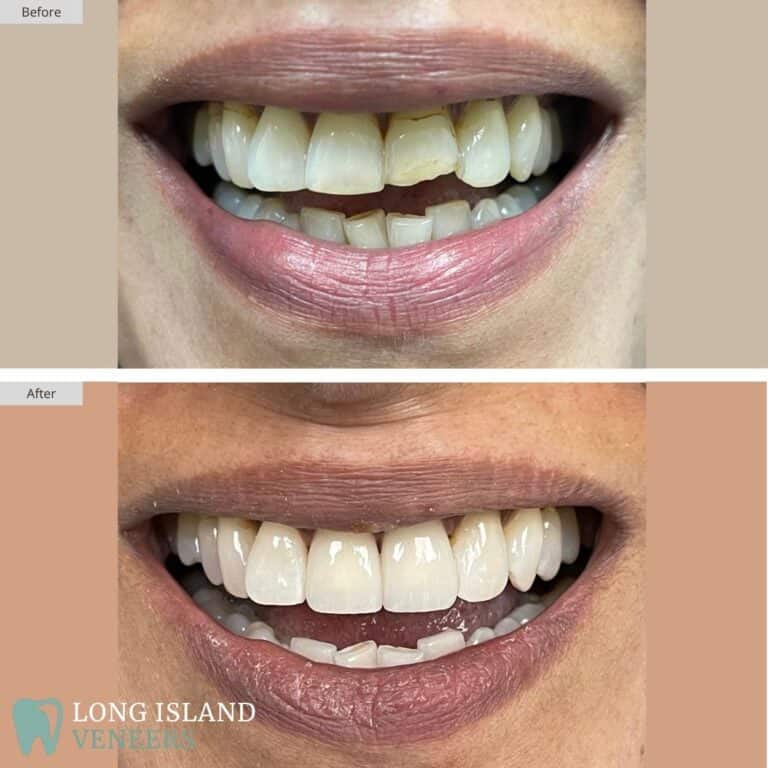 Long Island Veneers Before & After Patient 130