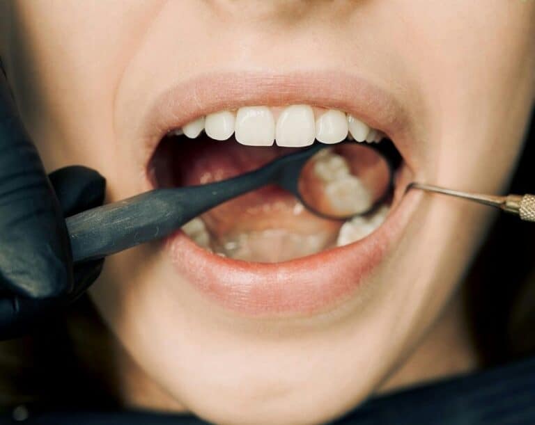 Should I Get Veneers