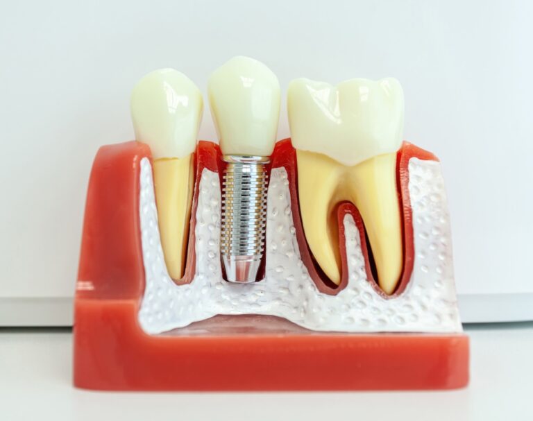 Dental Implants