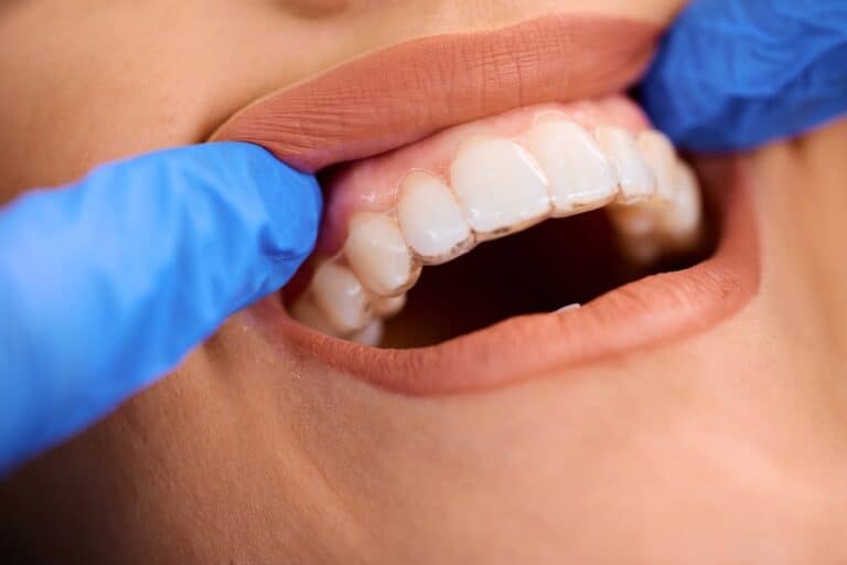 Invisalign Mouth