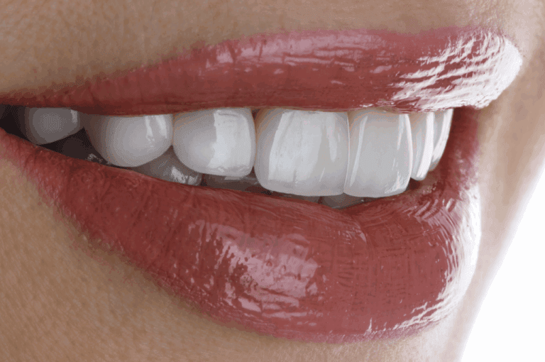 Veneers vs Implants