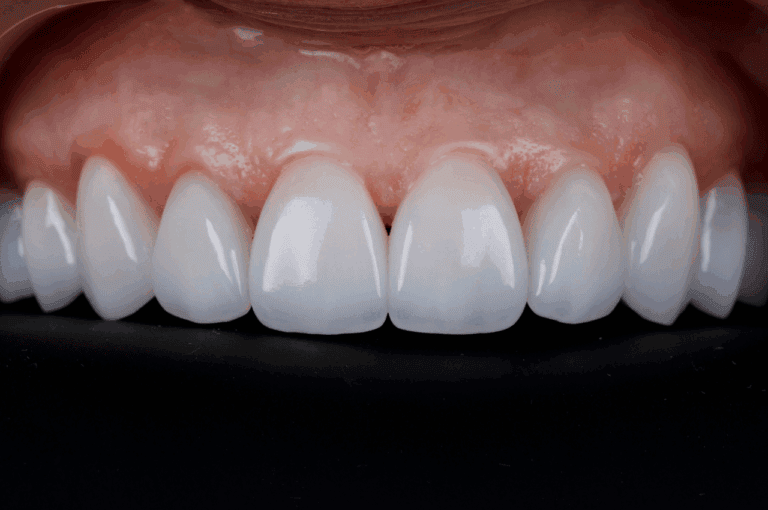benefits of veneers
