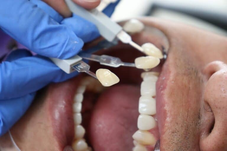 putting veneers on patient
