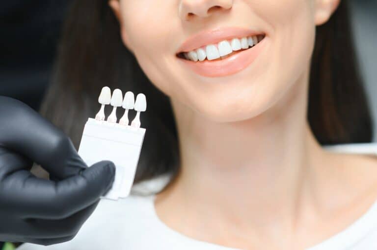 teeth color matching veneers