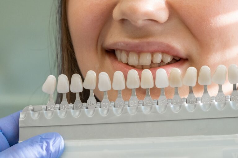 close up of woman's natural teeth and dental shade guide